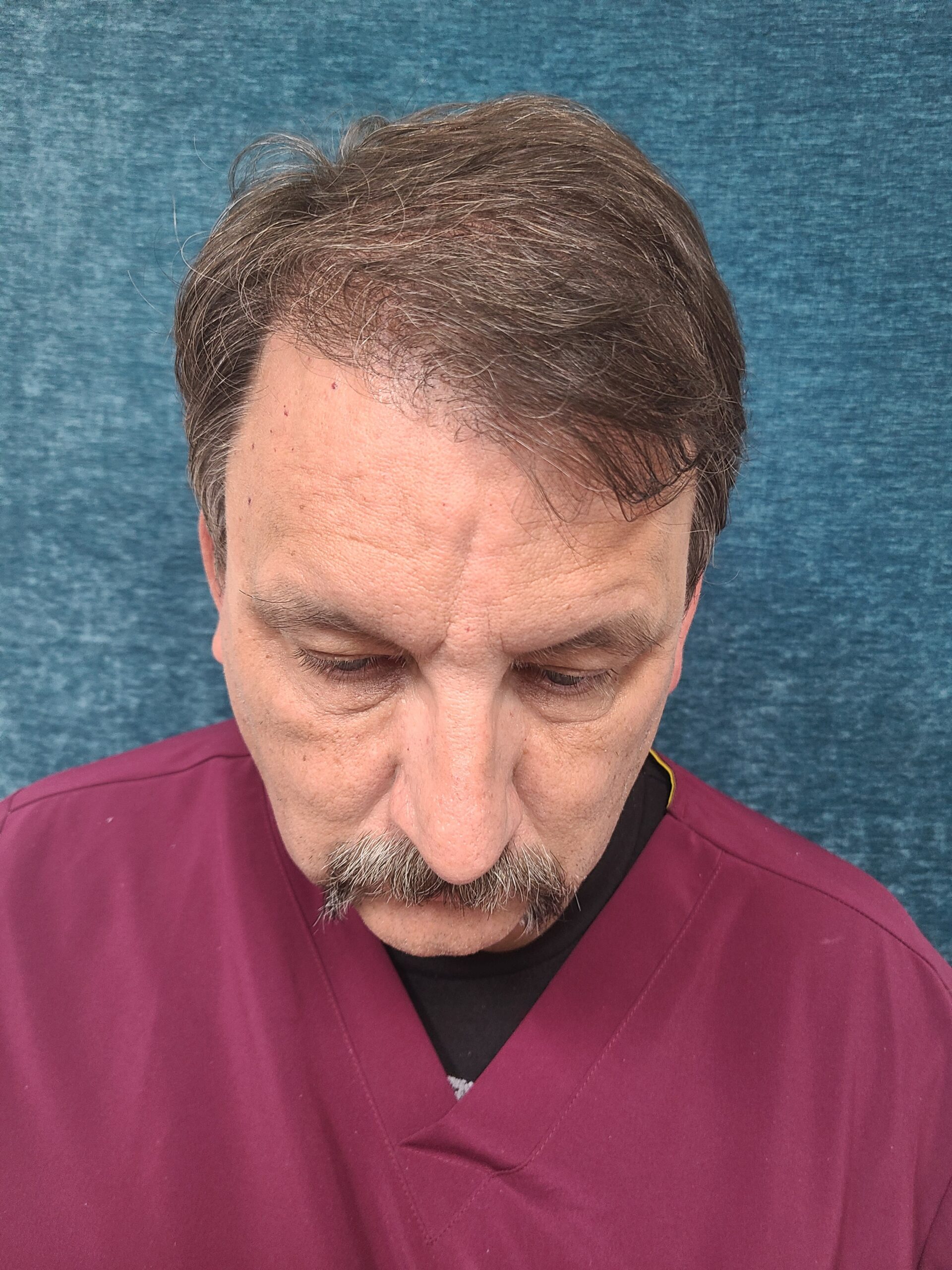 After-FUE Hair Transplant