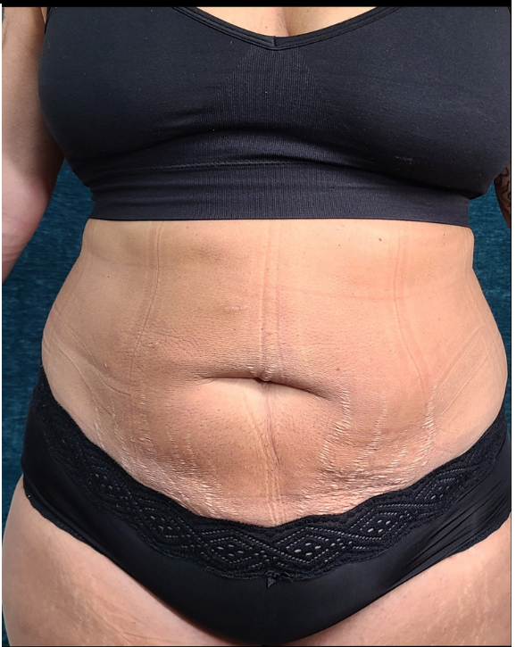 After-Liposuction