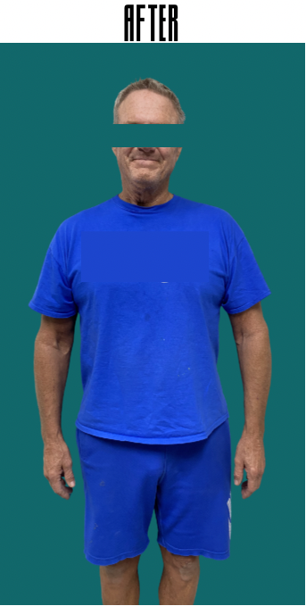 After-Medical Weight Loss