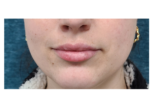 After-Lip Filler