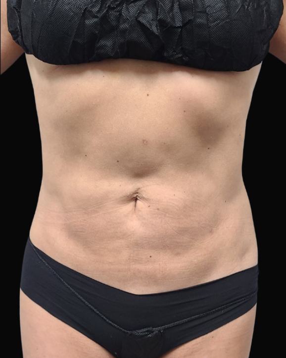 After-Liposuction