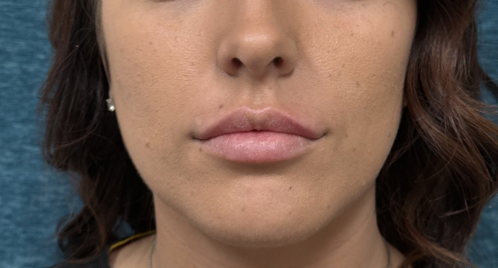 After-Lip Filler
