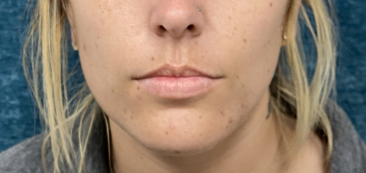 nBefore-Lip Filler