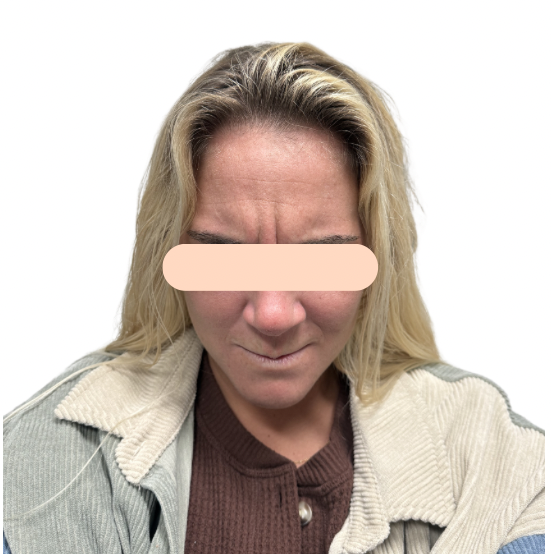After-Botox