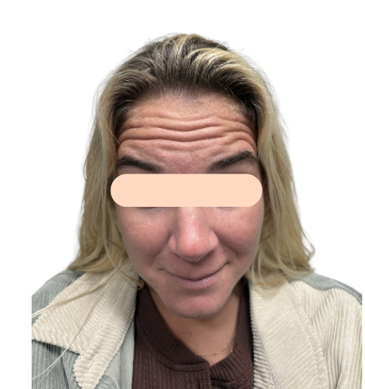 nBefore-Botox