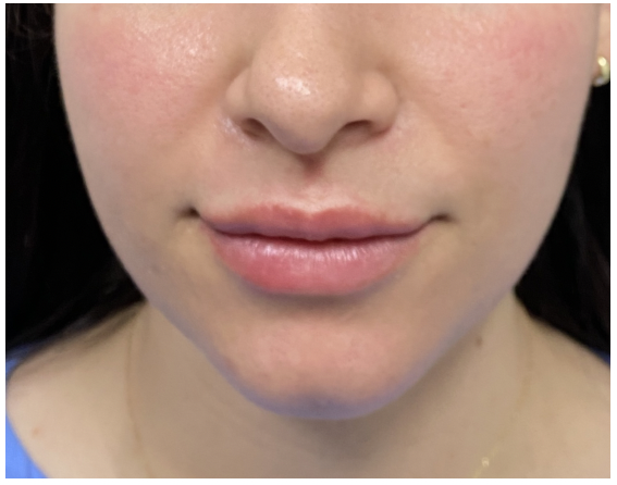 After-Lip Filler