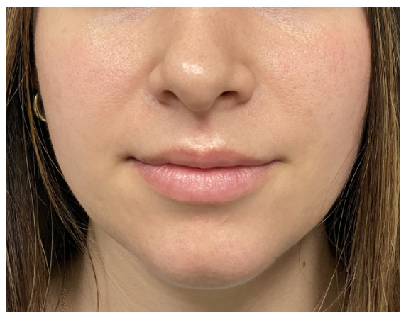 nBefore-Lip Filler